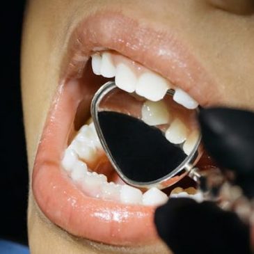 Tooth Decay : What is it?